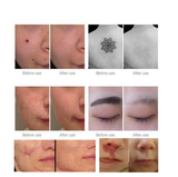 Home Laser Removal Pen for Tattoos Moles & Blemishes